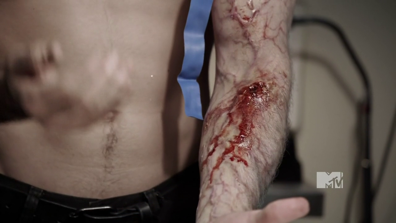 wolfsbane poisoning wolfsbane poisoning