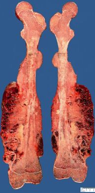 Osteossarcoma 5