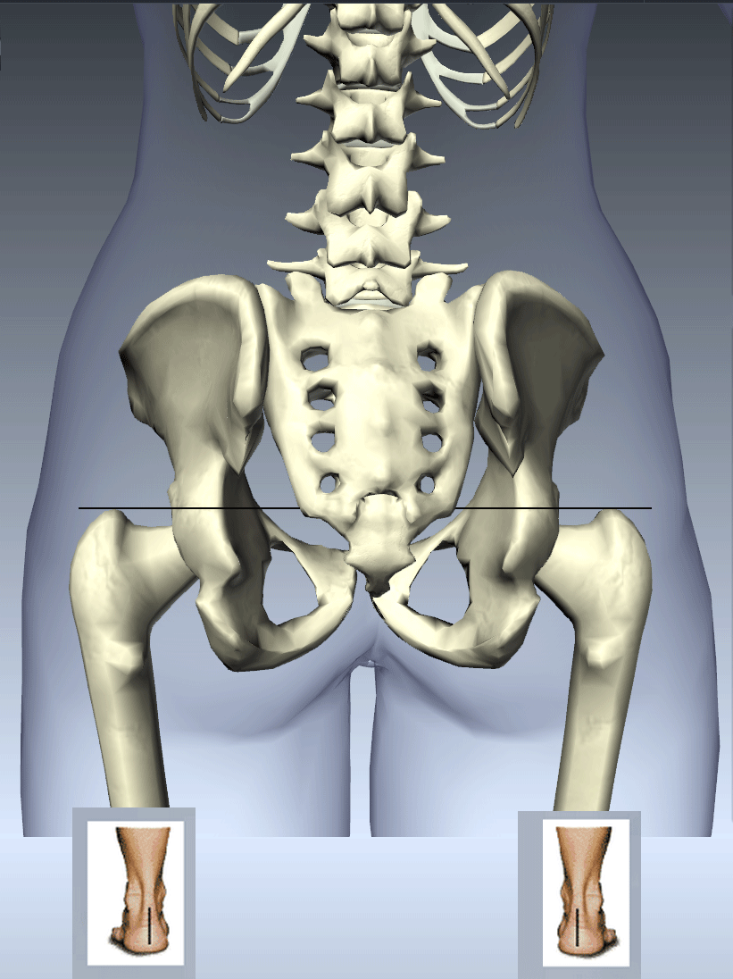 Functional leg length discrepancy foot to innominate link athletics